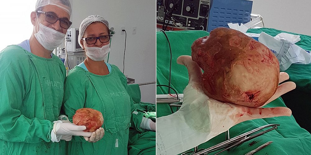 Baiano descobre em cirurgia que tinha pedra de quase 1,3 kg na bexiga